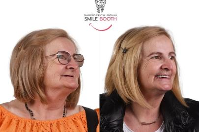 MARIA’YA UMUT OLAN ZİGOMA İMPLANT