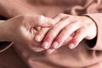 EKLEM AĞRILARININ SEBEBİ PSÖRİATİK ARTRİT OLABİLİR