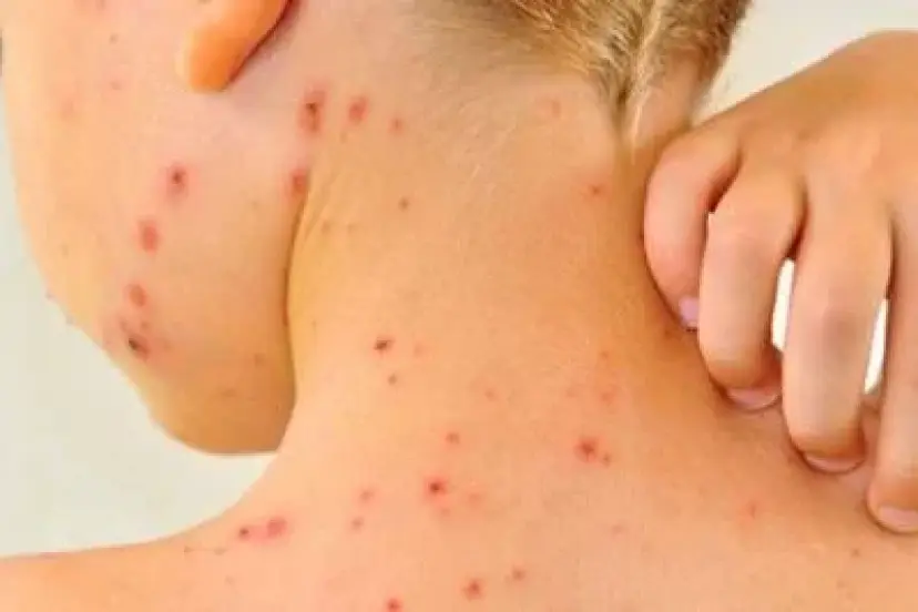 AŞISIZLIK ALARMI: KIZAMIK GERİ DÖNDÜ